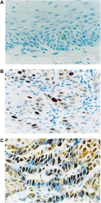 Expression of p53 in toluidine blue positive oral squamous cell carcinoma lesions and expression of Ki67 in vinegar positive oral squamous cell carcinoma lesions